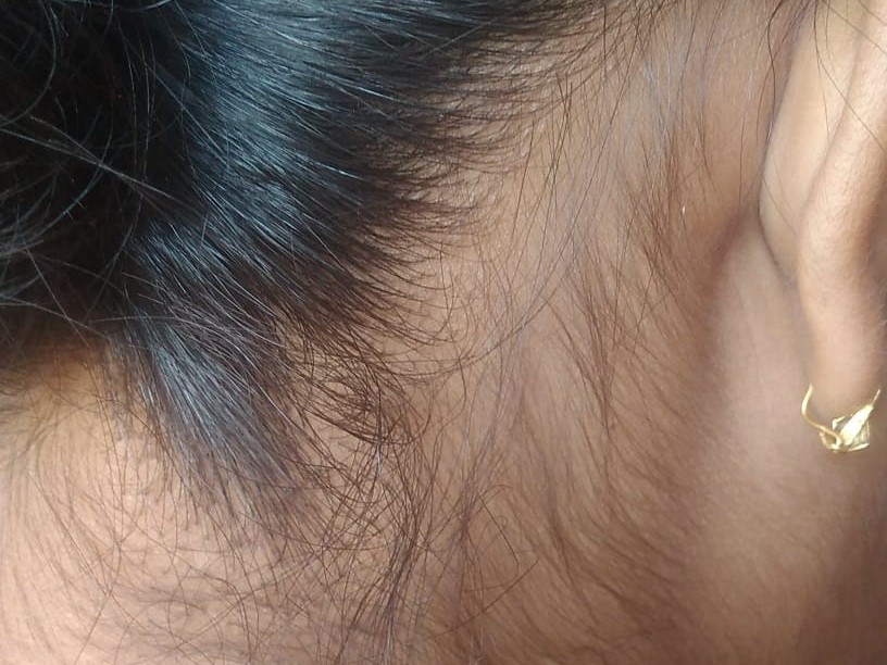 Alopecia Areata after treatment