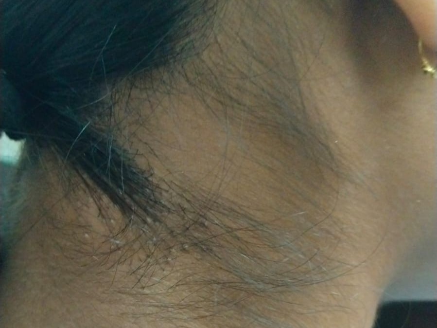 Alopecia Areata before treatment